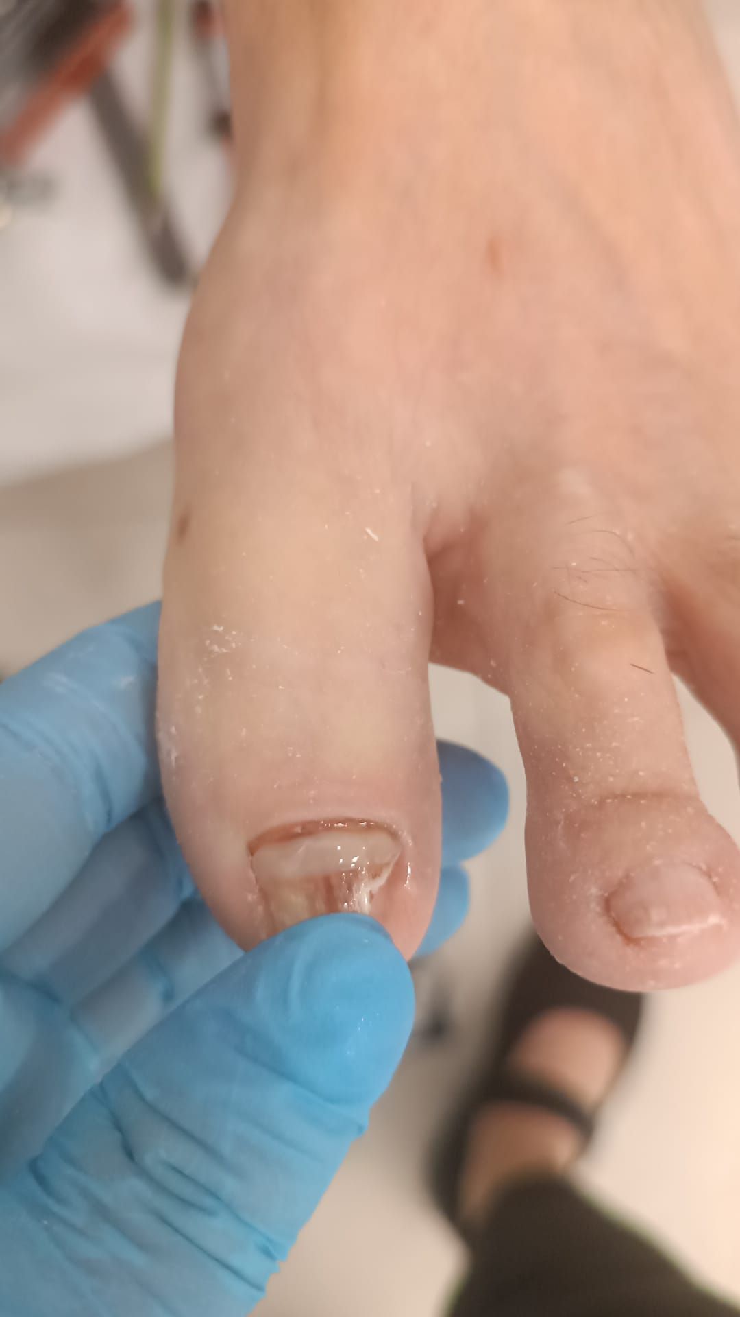 Unha fragilizada e com forma alterada